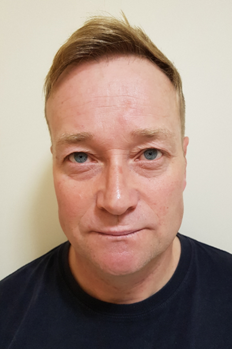 Before & After — before (pre-operative)